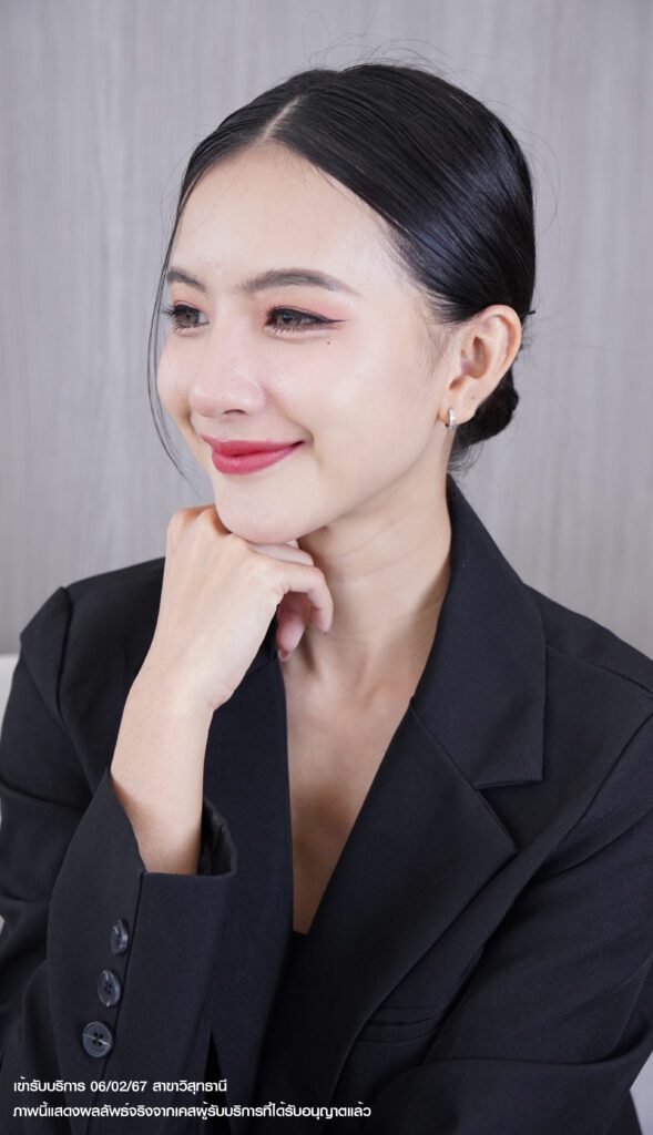 รีวิวเสริมจมูก_ช่วงสัมภาษณ์02