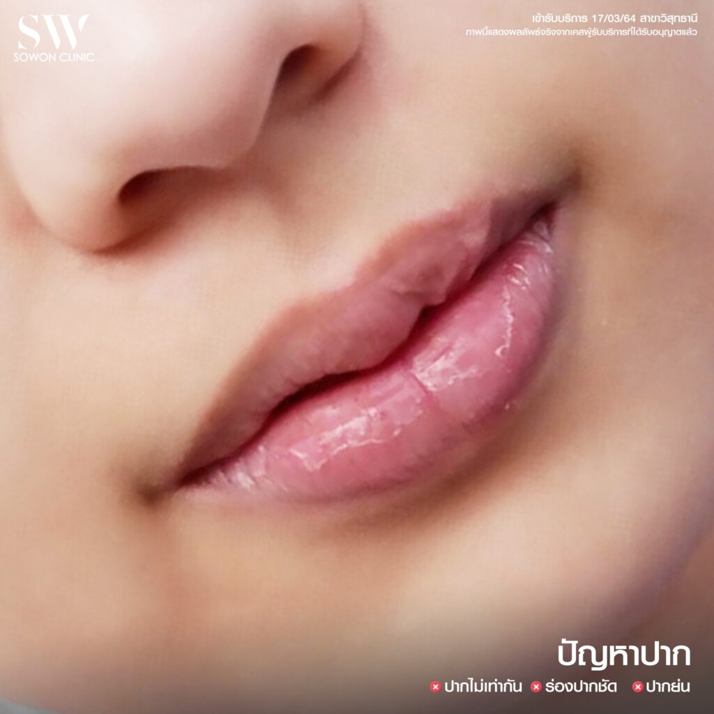ปัญหาปากกระจับ