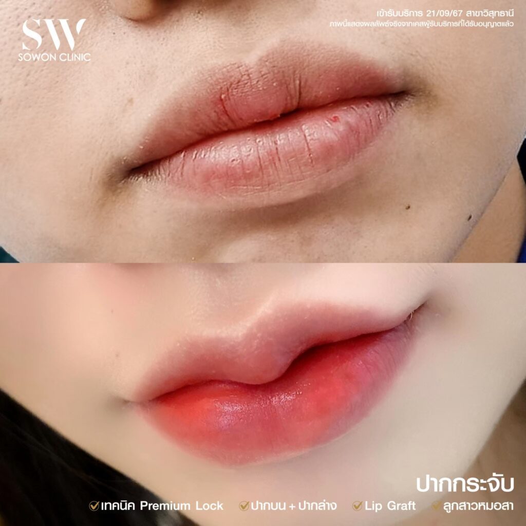 รีวิวปากกระจับบน+ล่าง