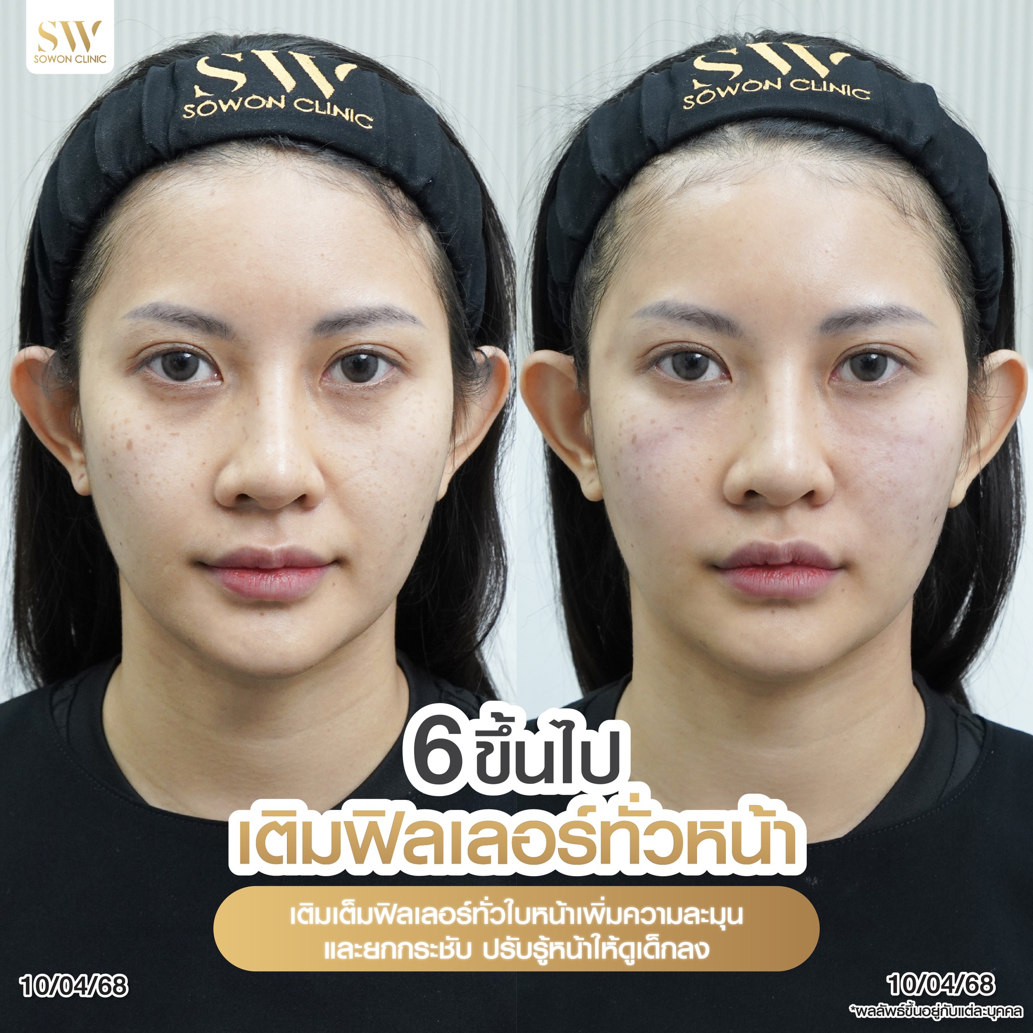 เติมโปรแกรมฟิลเลอร์ทั่วหน้า