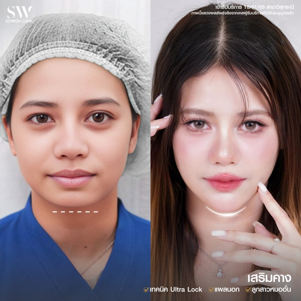 เสริมคาง ปัญหา