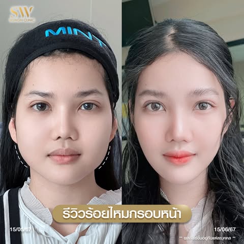 โปรโมชั่นร้อยไหมรีวิว 09