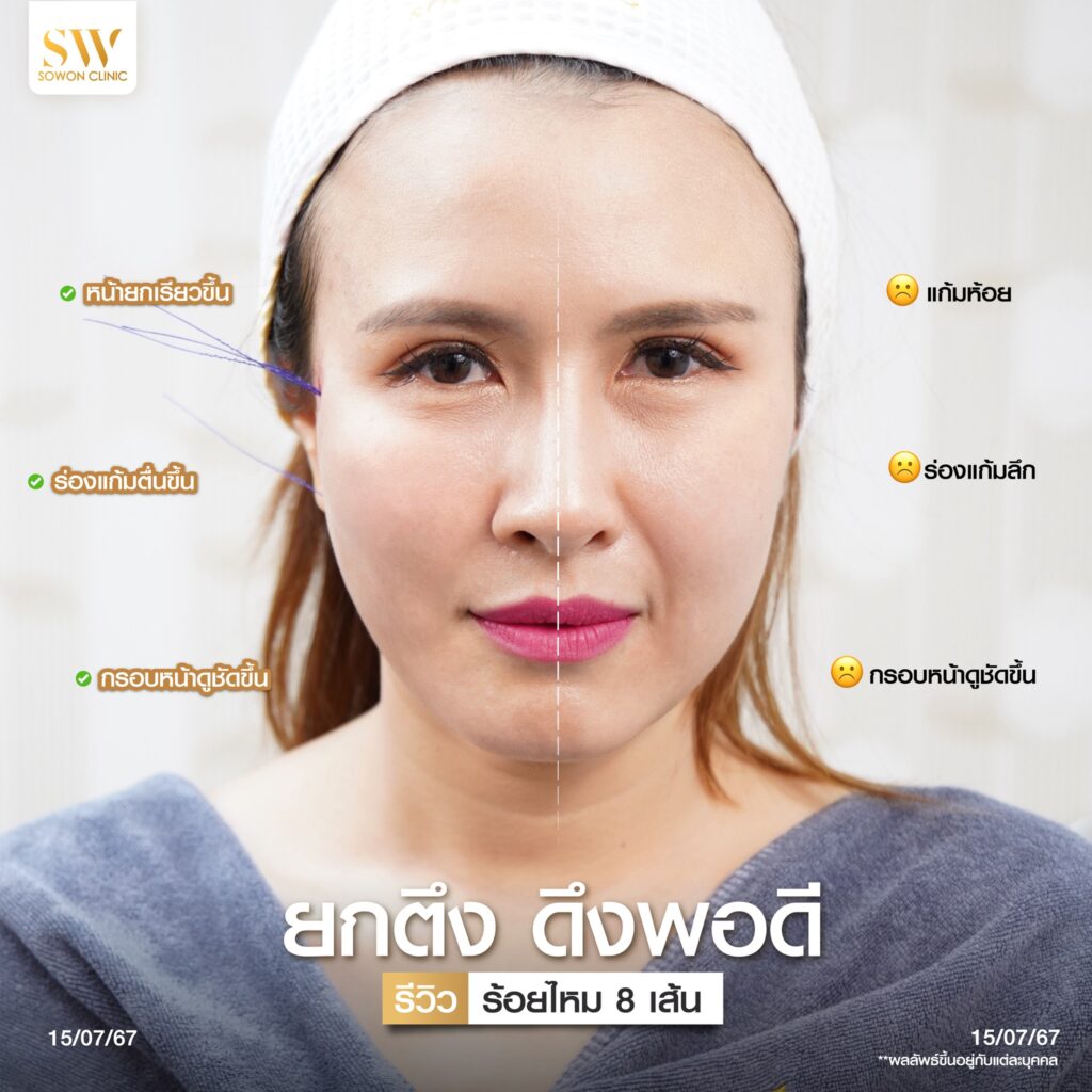 โปรโมชั่นร้อยไหม ปัญหา