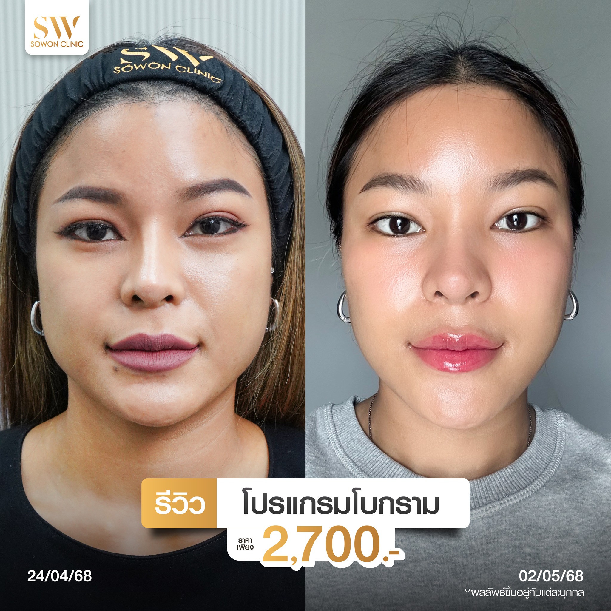 โปรแกรมลดกรามหน้าเรียว_รีวิว08