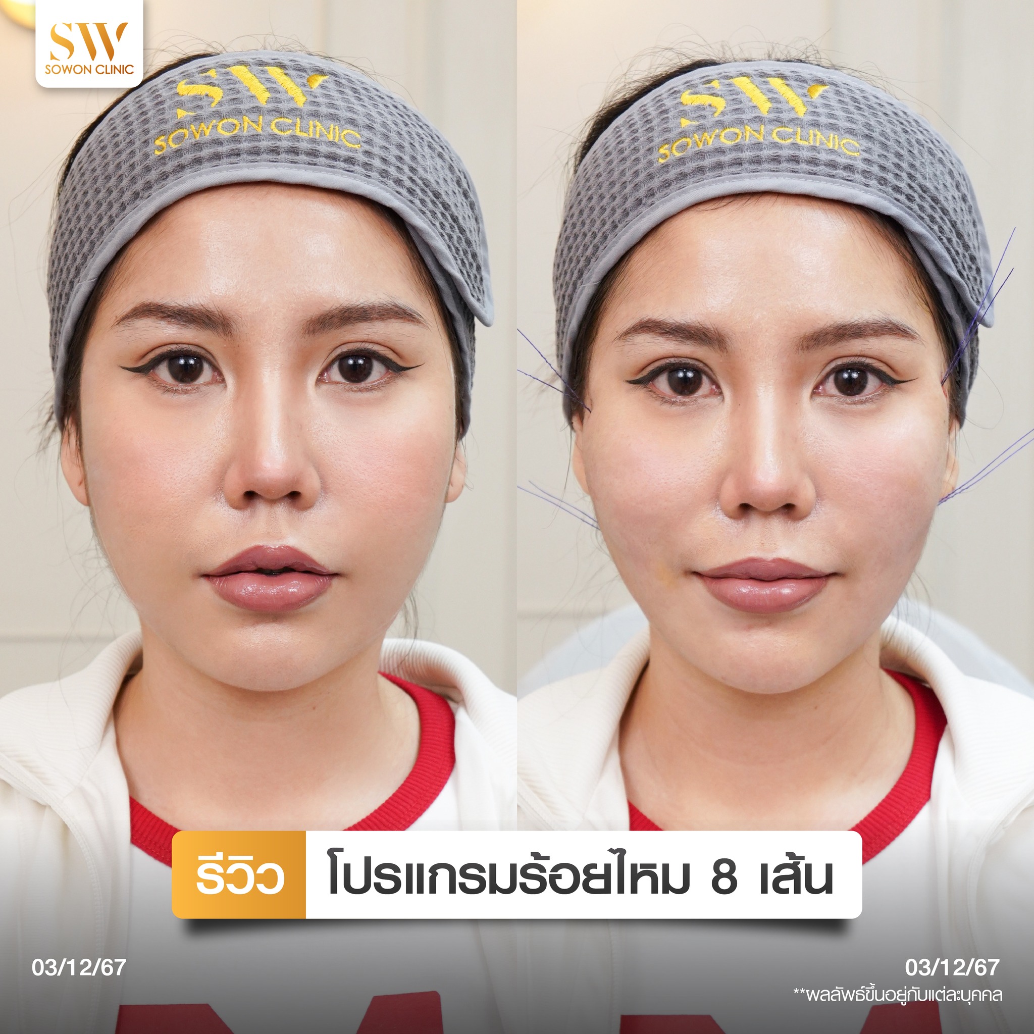 โปรโมชั่นร้อยไหมรีวิว 06