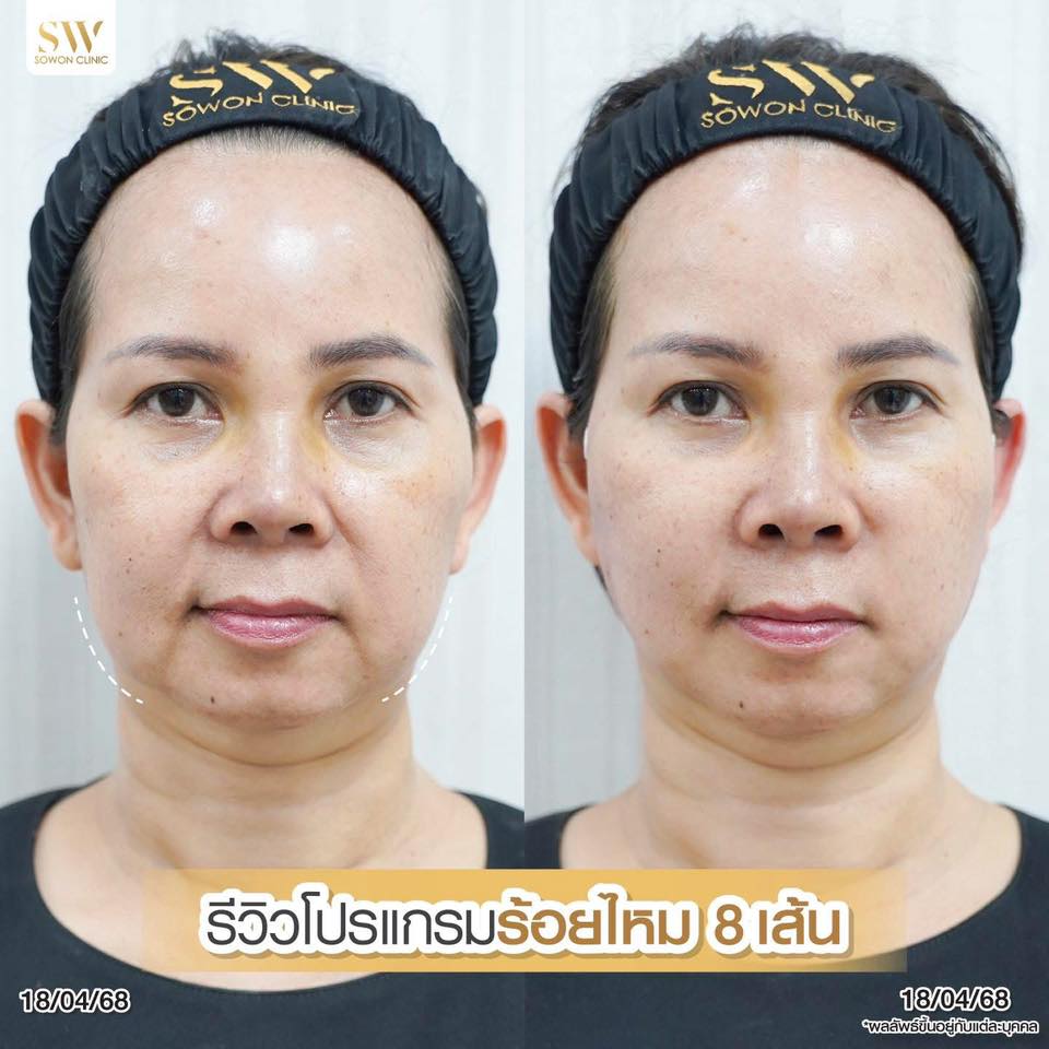 โปรโมชั่นร้อยไหมรีวิว 08