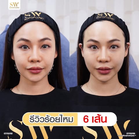 โปรโมชั่นร้อยไหมรีวิว 02
