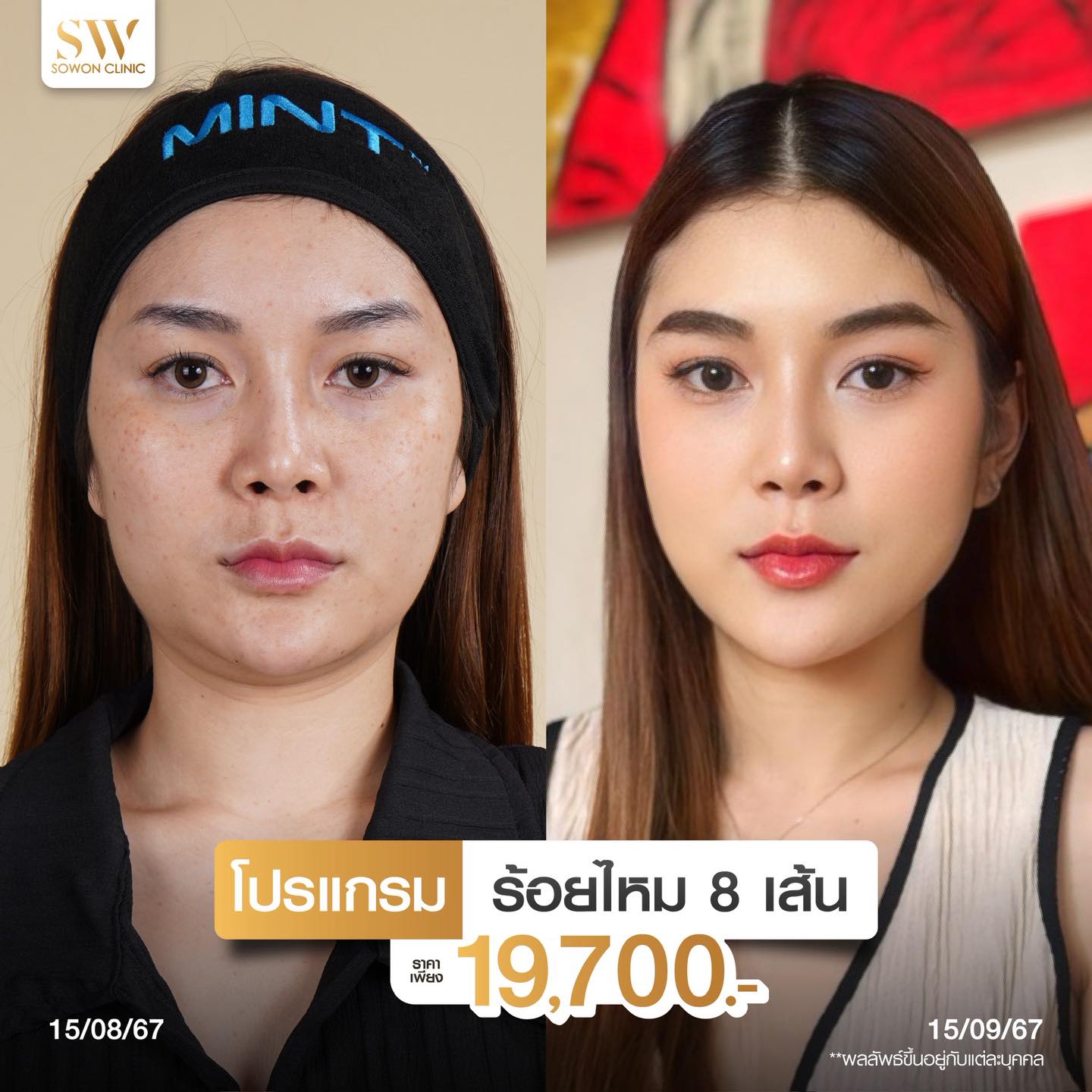 โปรโมชั่นร้อยไหมรีวิว 03