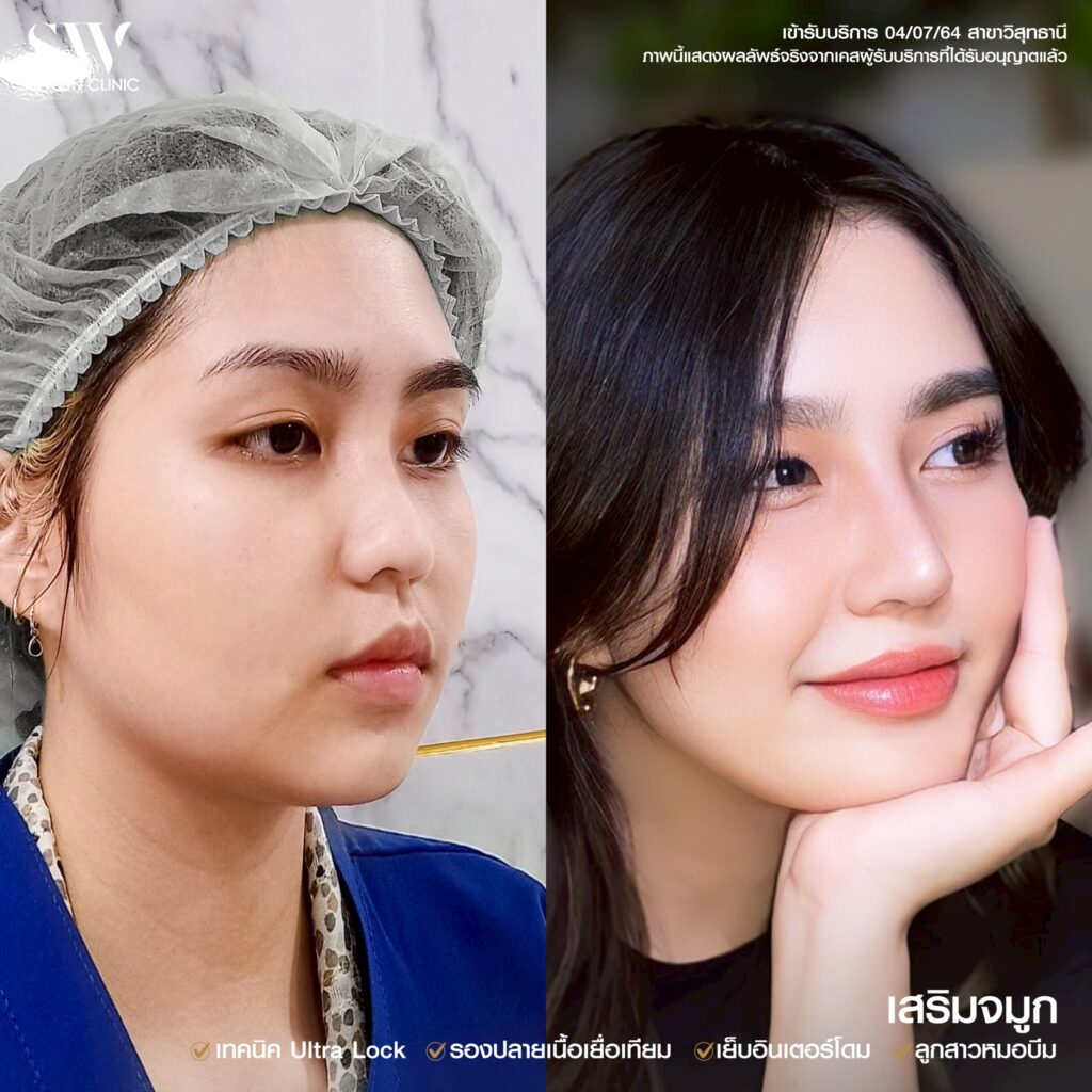 เสริมจมูกโซวอน เสริมจมูกครบ3ปี คุณเฟรม