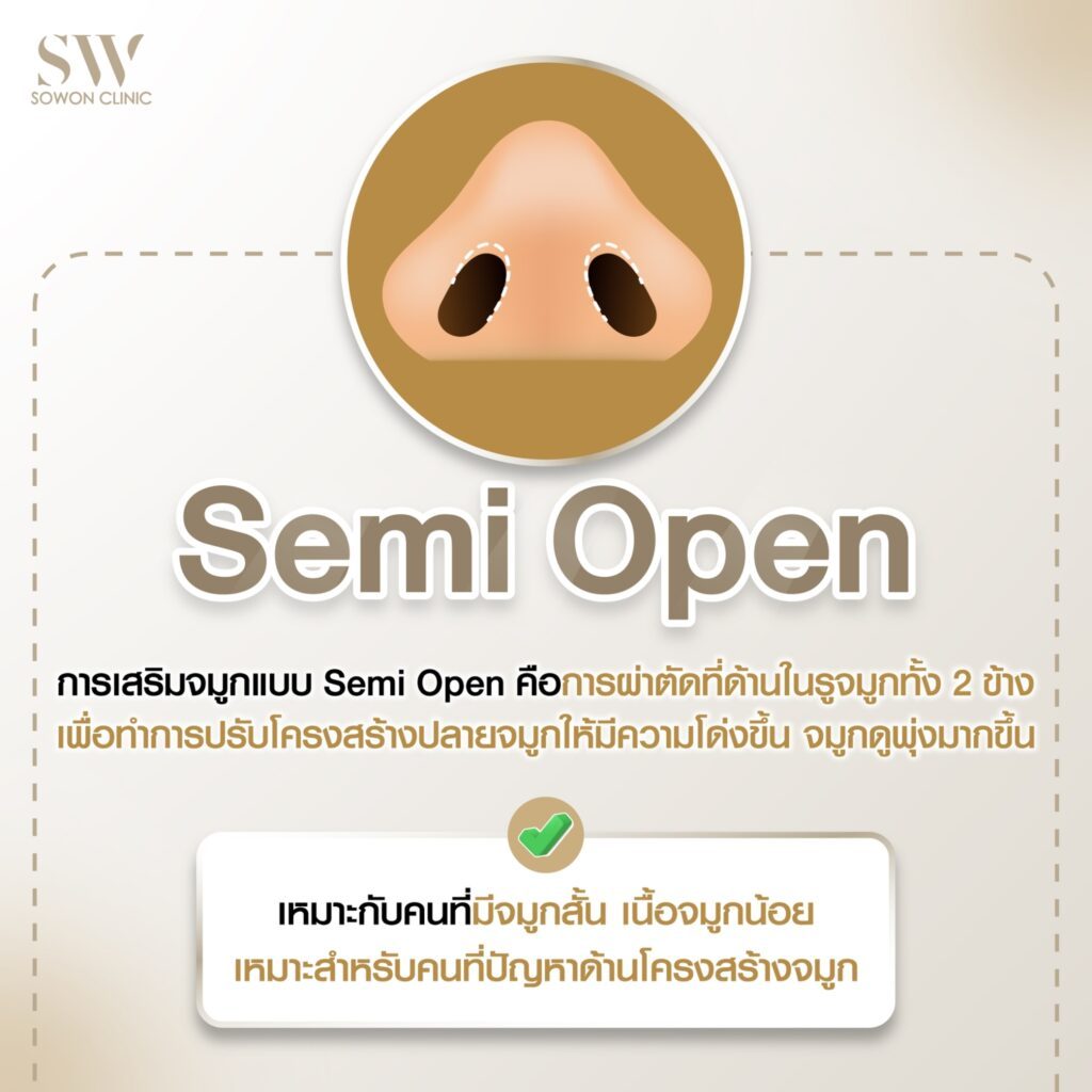 เสริมจมูกครั้งแรกที่ไหนดี การเสริมจมูกแบบกึ่งเปิด