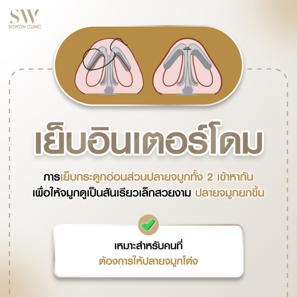 เสริมจมูกครั้งแรกที่ไหนดี การเย็บอินเตอร์โดม 