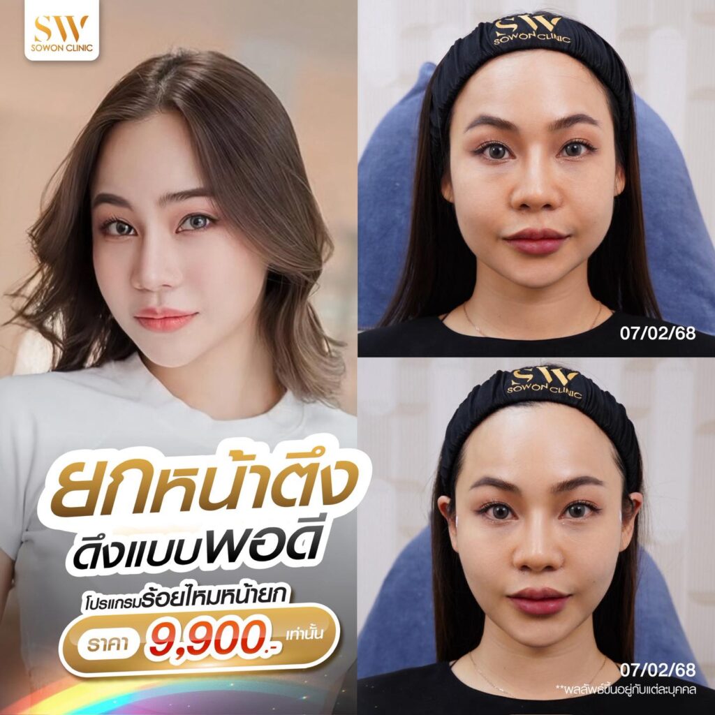 โปรโมชั่นร้อยไหมมิ้นท์ โปร
