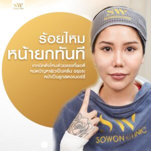 โปรโมชั่นร้อยไหมมิ้นท์ เทคนิคที่ถูก01