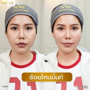 โปรโมชั่นร้อยไหมมิ้นท์ เทคนิคที่ถูก04