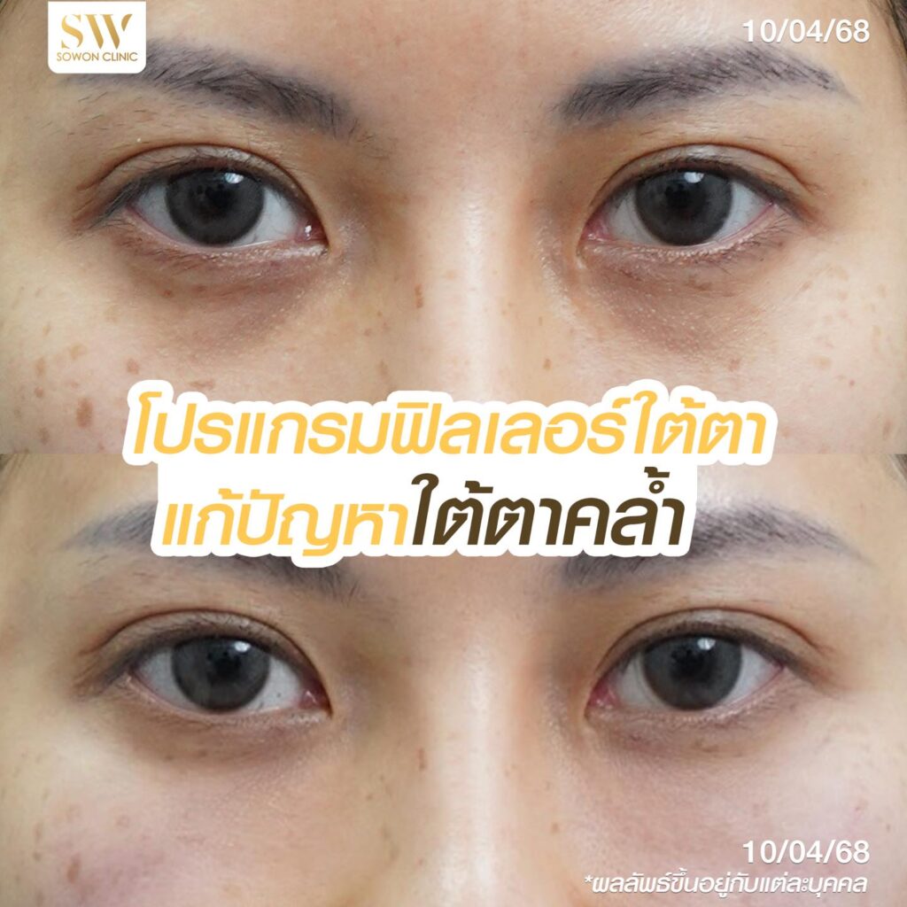 ฟิลเลอร์ใต้ตา ปัญหา 02