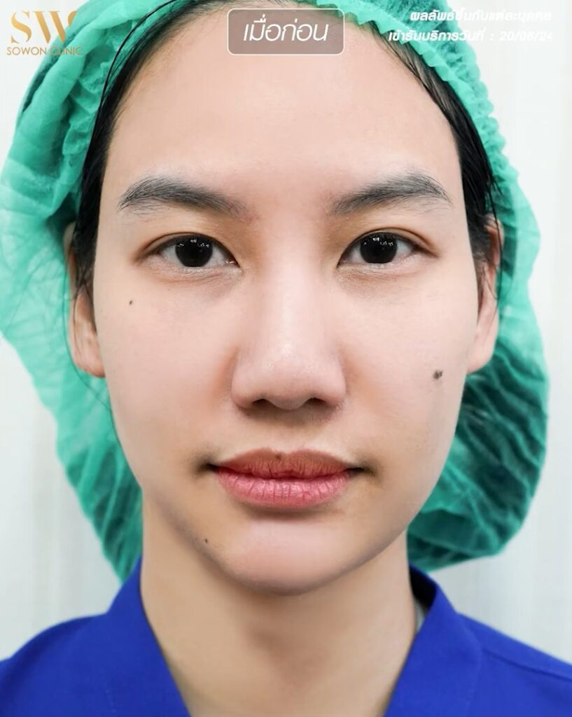 รีวิวปากกระจับ ก่อนทำแม่ไข่ขาว