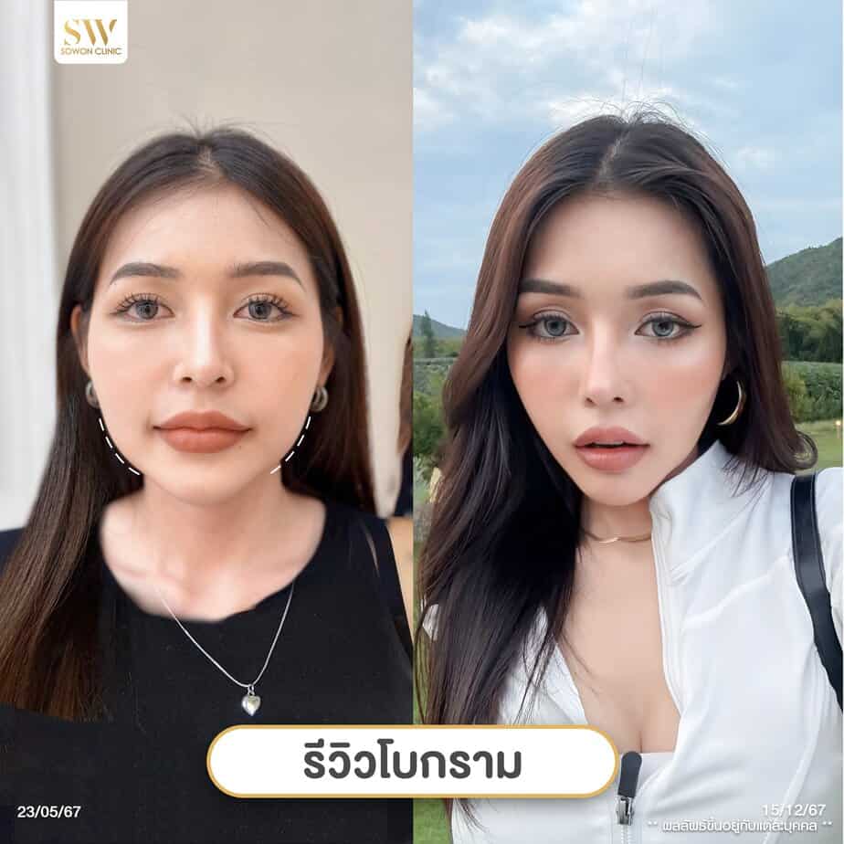 โปรโมชั่นโบสุดพิเศษ โปรแกรมลดกรามหน้าเรียว_รีวิว