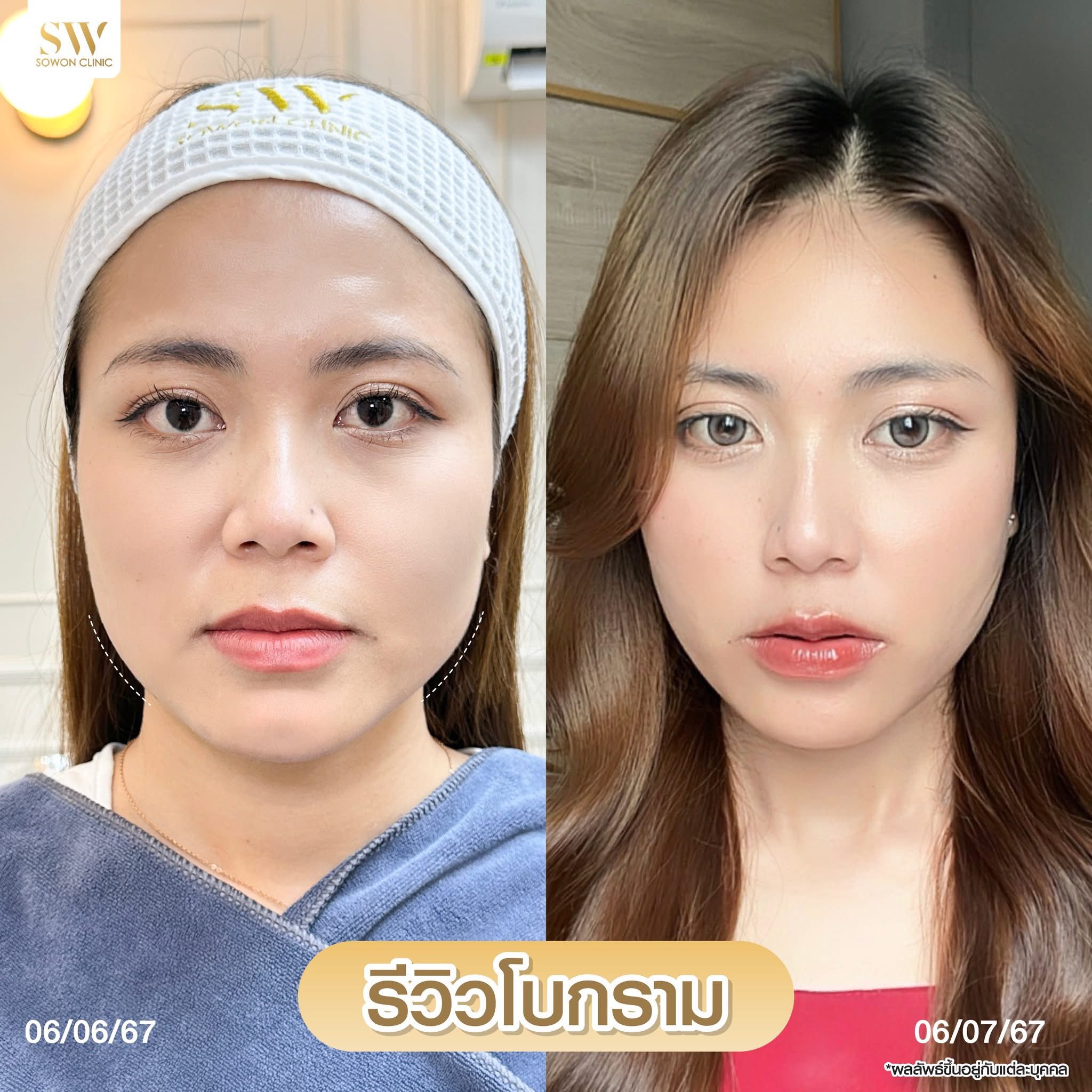 โปรแกรมลดกรามหน้าเรียว_รีวิว03