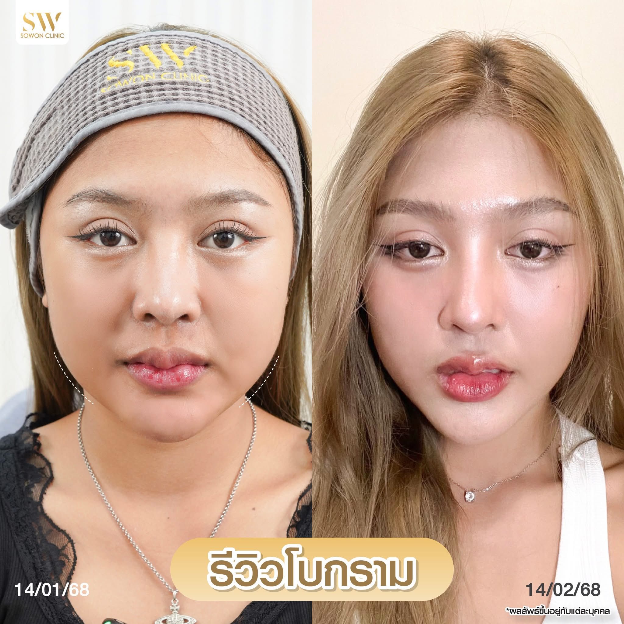 โปรแกรมลดกรามหน้าเรียว_รีวิว06