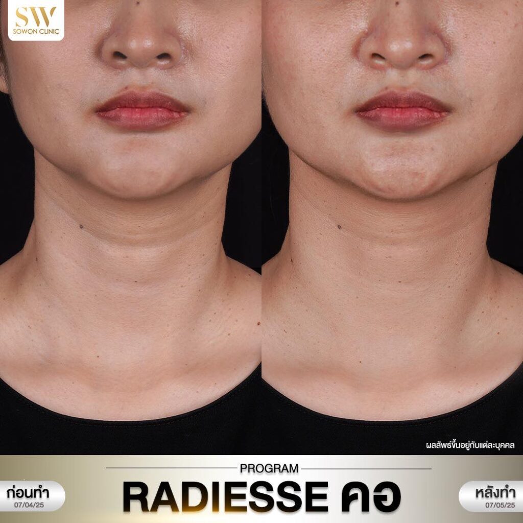 Radiesse คอพี่ครีม