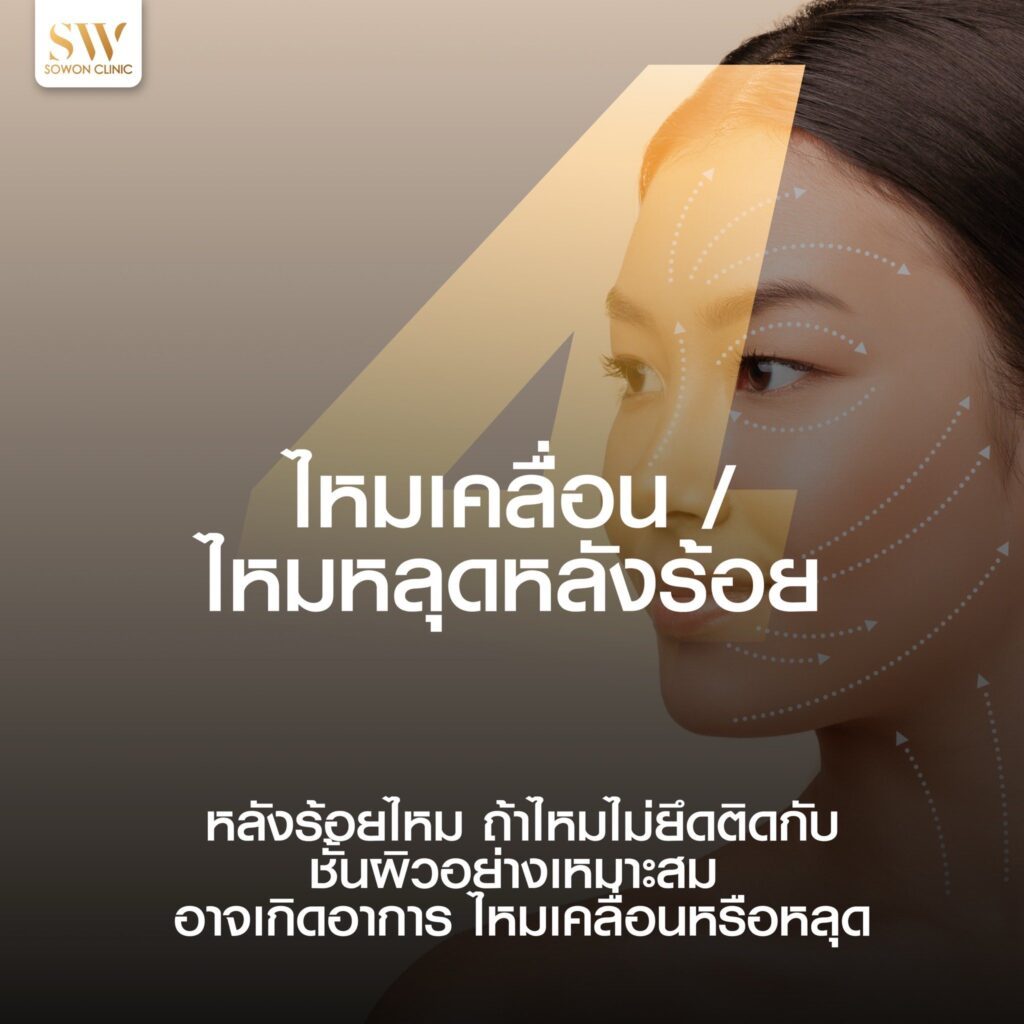 ร้อยไหมหน้าเรียว_4 ด้านมืดของการร้อยไหม ข้อ 4 