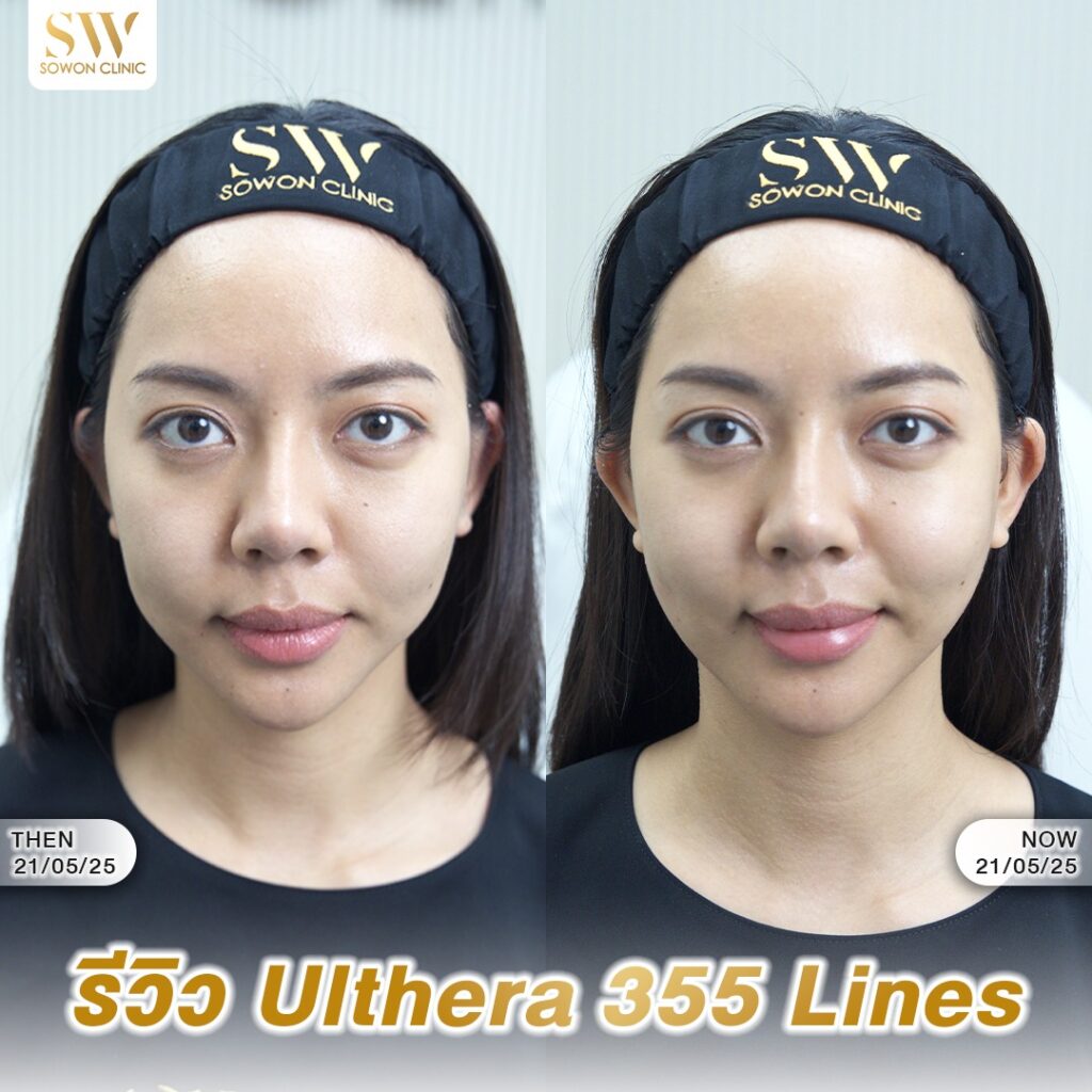 ยกกระชับหน้า_ulthera_review02