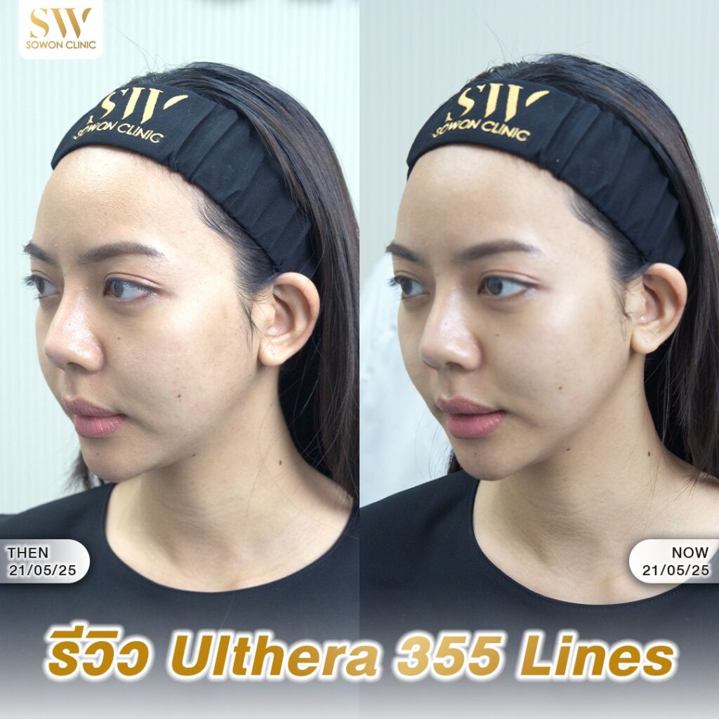 ยกกระชับหน้า_ulthera_review01
