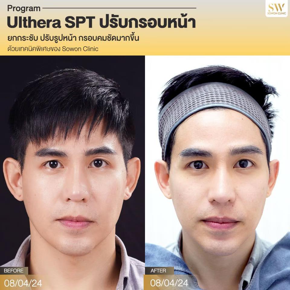 ยกกระชับหน้า_ulthera_review07