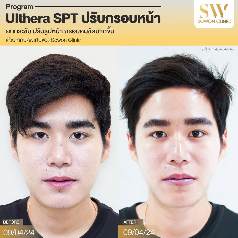 ยกกระชับหน้า_ulthera_review05