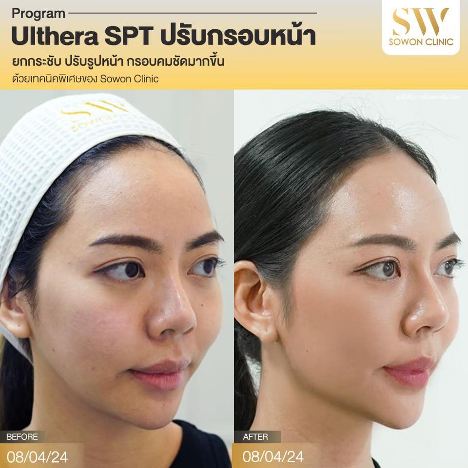 ยกกระชับหน้า_ulthera_review03
