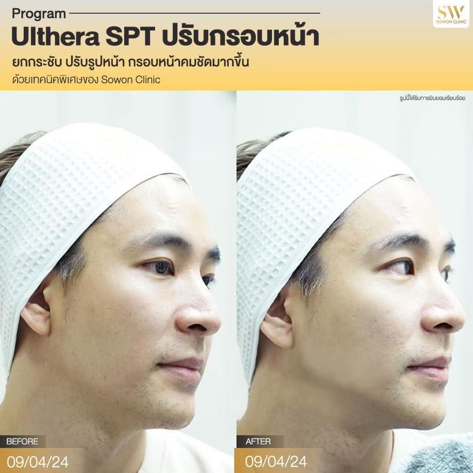 ยกกระชับหน้า_ulthera_review04