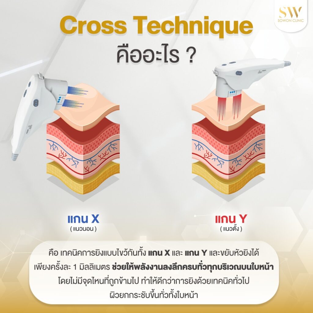 ยกกระชับหน้า เทคนิค Cross Technique