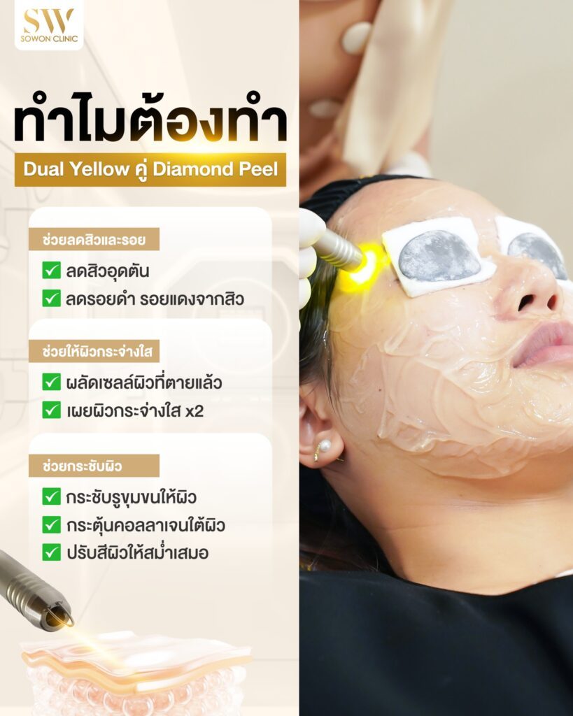 เลเซอร์หน้าใส Dual Yellow คู่ Diamond Peel