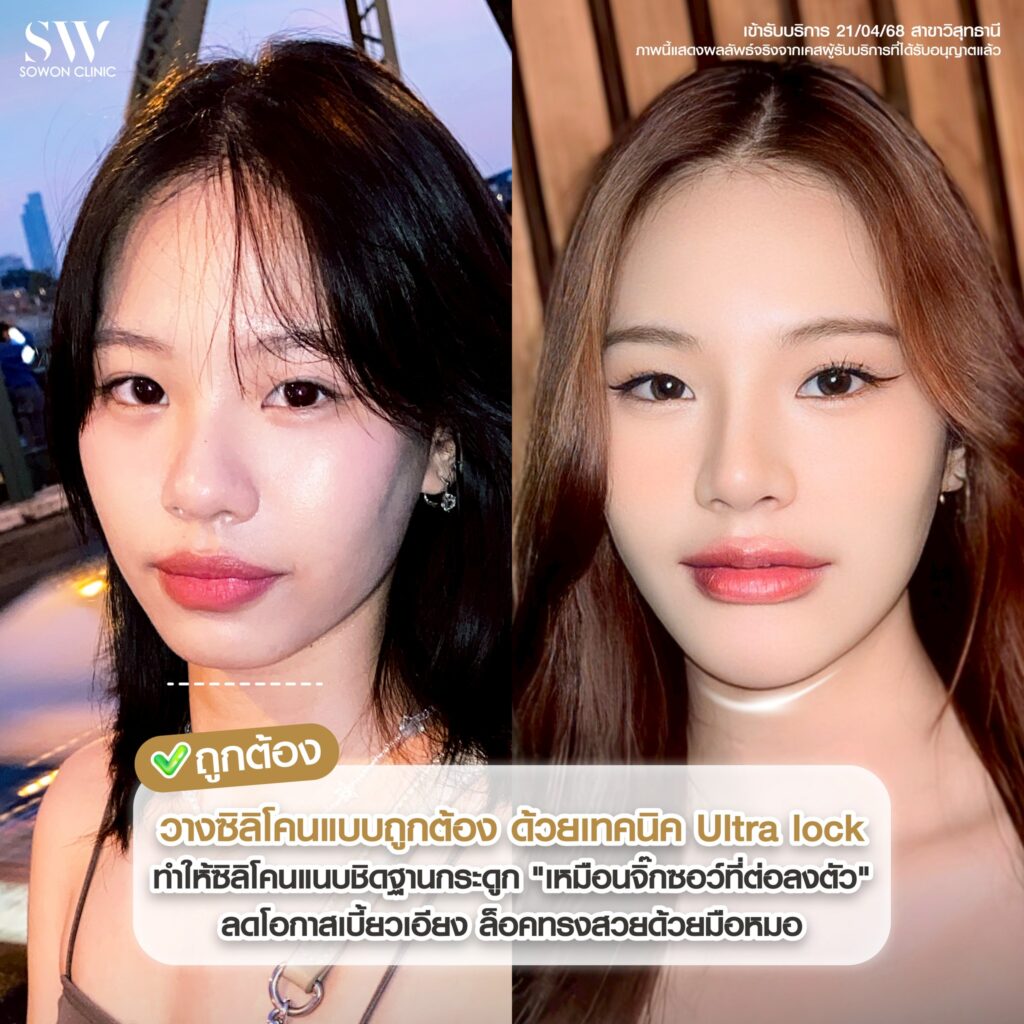 ทำไมต้องเสริมคางที่ Sowon 3