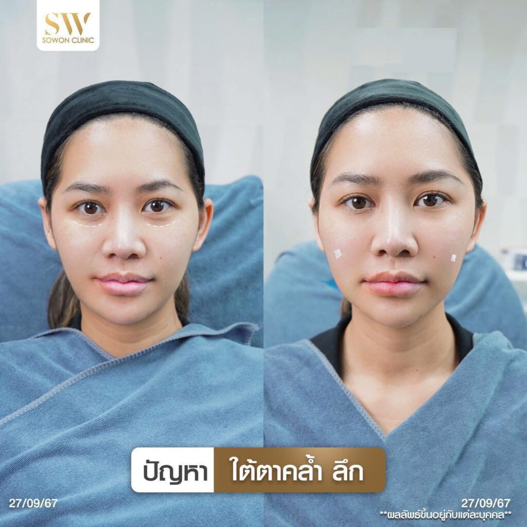 ปัญหาใต้ตา