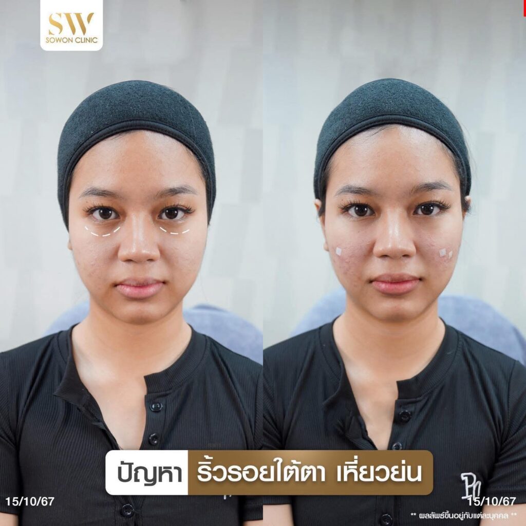 ปัญหาใต้ตา 2