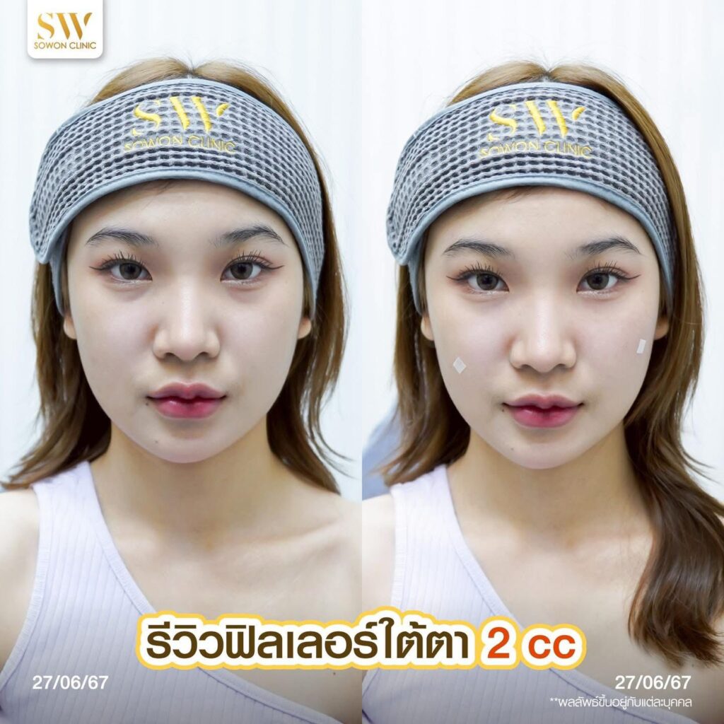 โปรแกรมฟิลเลอร์ใต้ตา