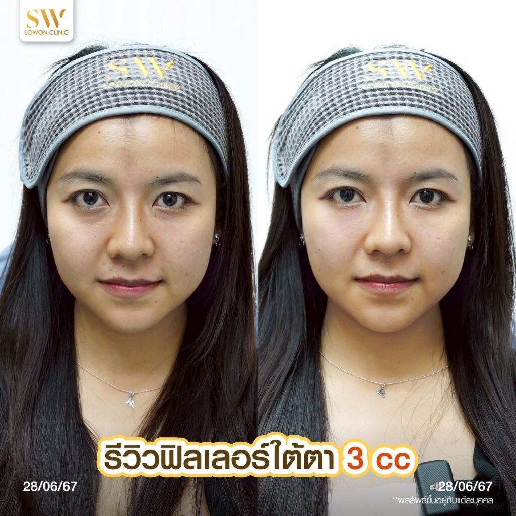 โปรแกรมฟิลเลอร์ใต้ตา 2