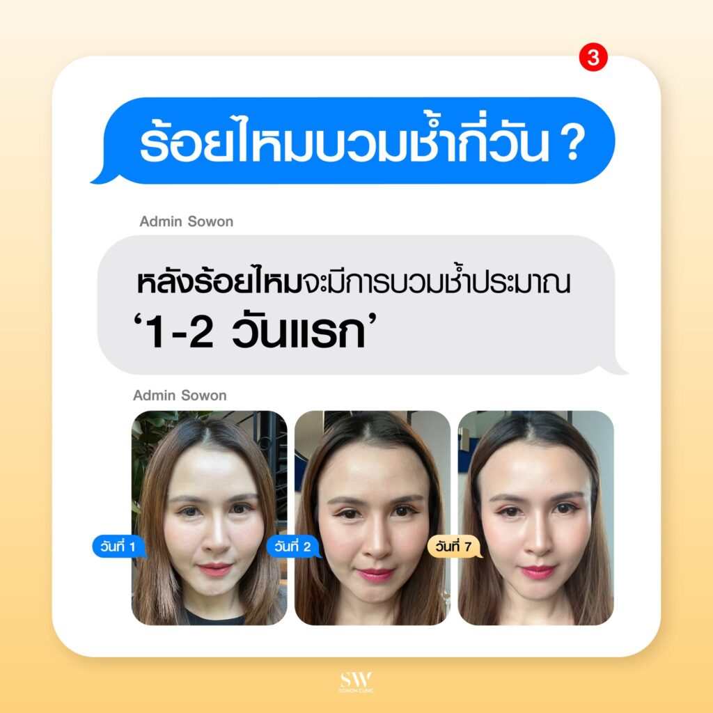 ร้อยไหมหน้าเรียว ร้อยไหมบวมช้ำกี่วัน.