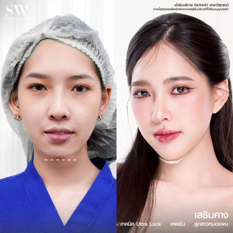 เสริมคาง 5