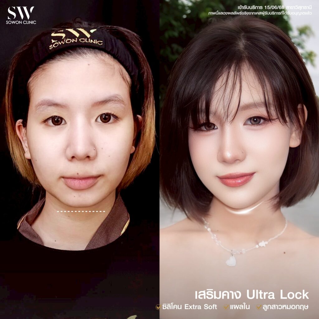 เสริมคางสวย 2