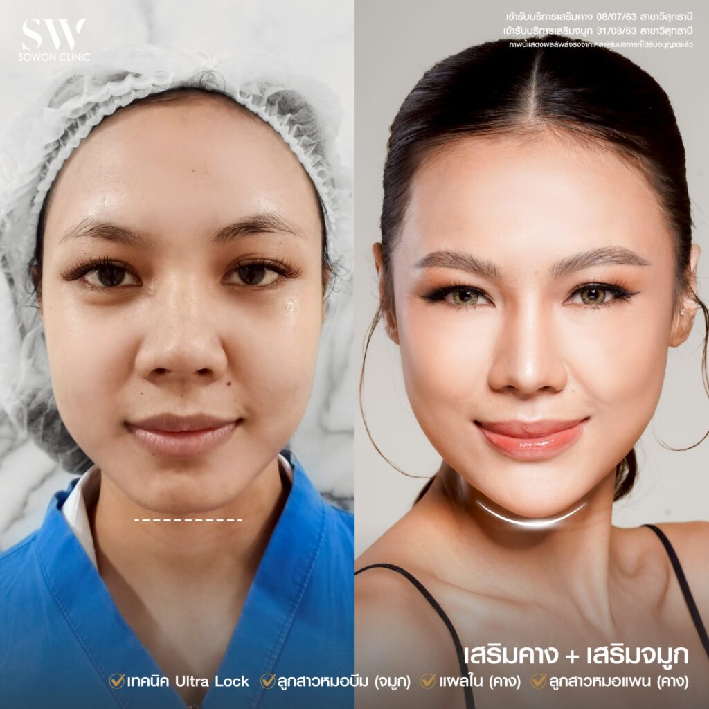 เสริมจมูก คาง 4