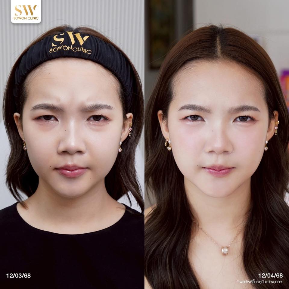 โบริ้วรอยหว่างคิ้ว