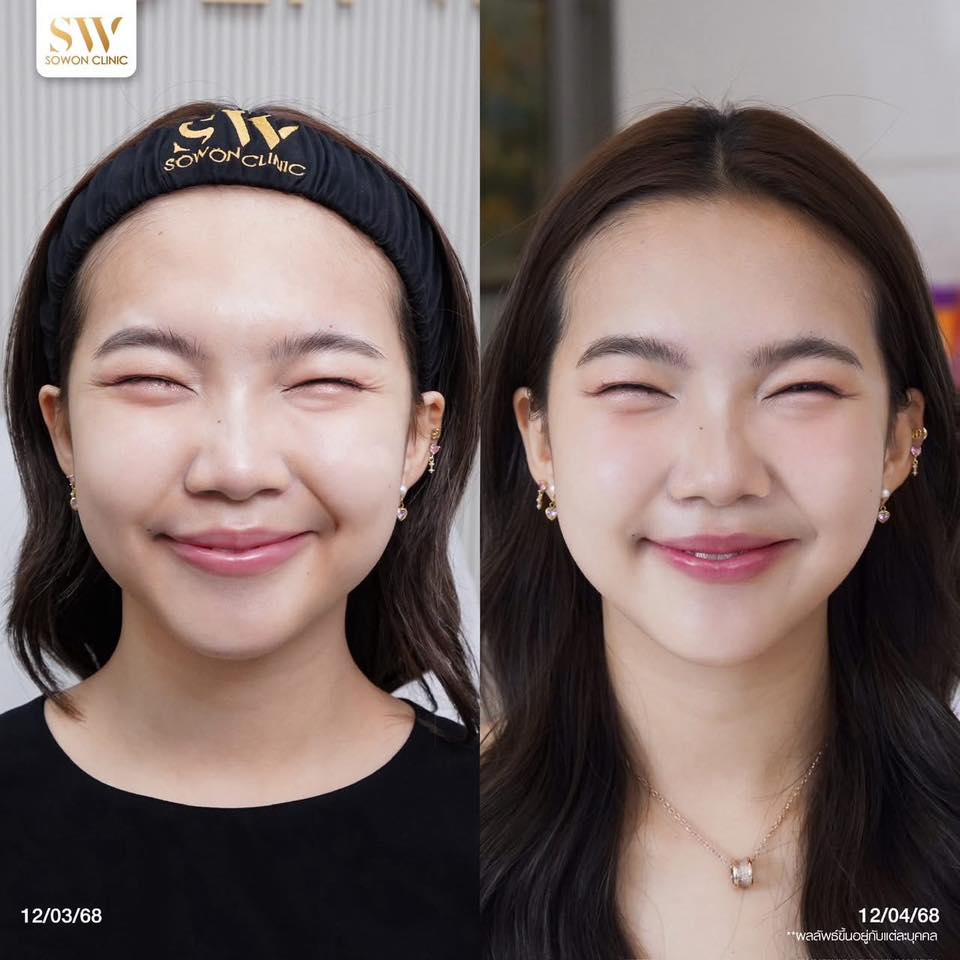 โบริ้วรอยหางตา
