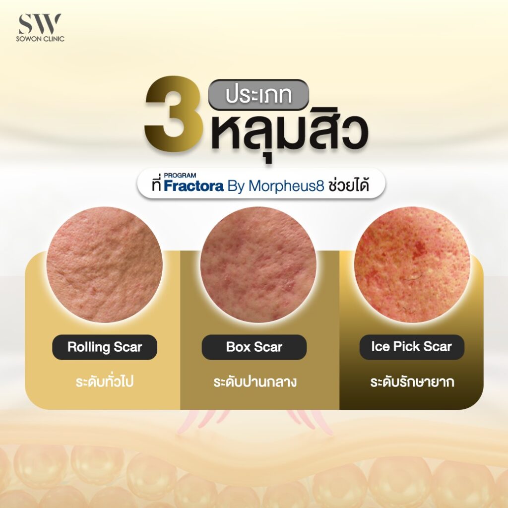 หลุมสิว 3 ปัญหาหลุมสิว