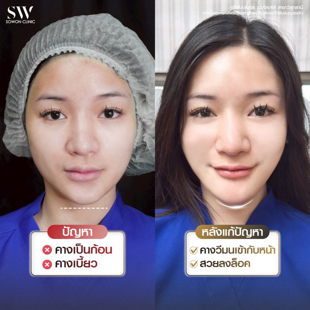 รีวิวเสริมคาง วิเคราะห์เคส