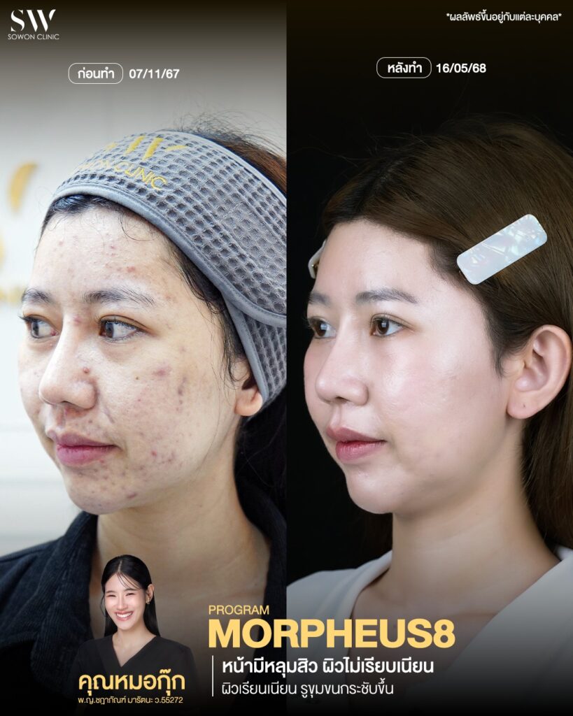 หลุมสิว รีวิว