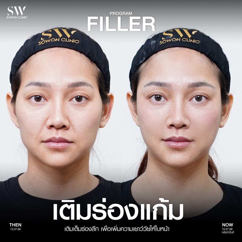 หน้าเด็ก ฟิลเลอร์ร่องแก้ม
