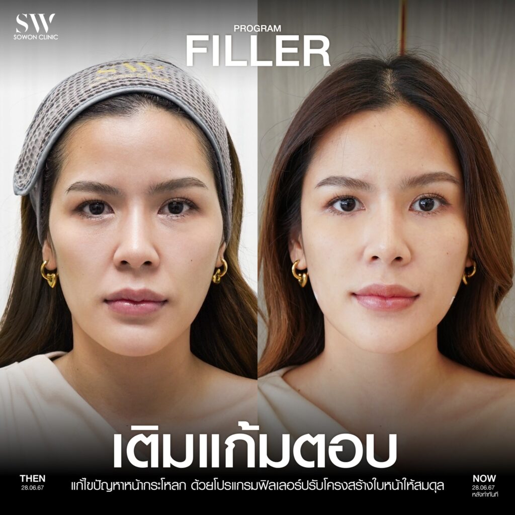 หน้าเด็ก ฟิลเลอร์แก้มตอบ