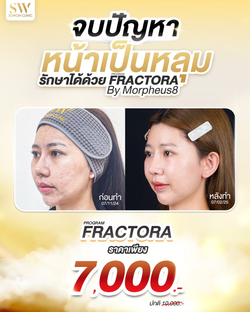 หลุมสิว Sowon Clinic